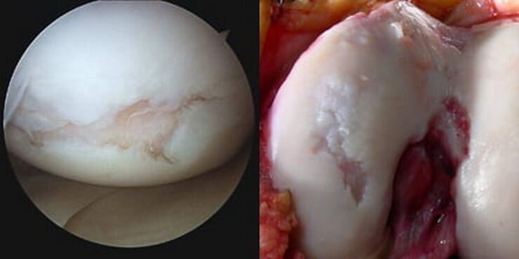Il danno all'articolazione del ginocchio è visibile durante l'operazione