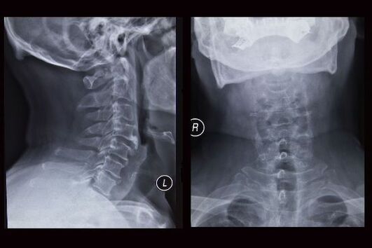 Radiografia del rachide cervicale (il paziente ha l'osteocondrosi)