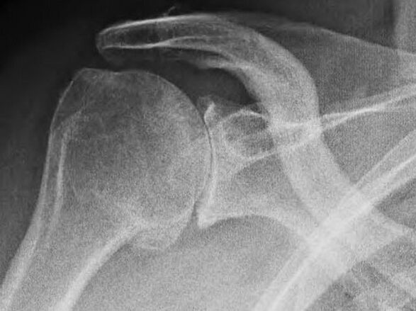 Radiografia di un'articolazione della spalla affetta da osteoartrosi