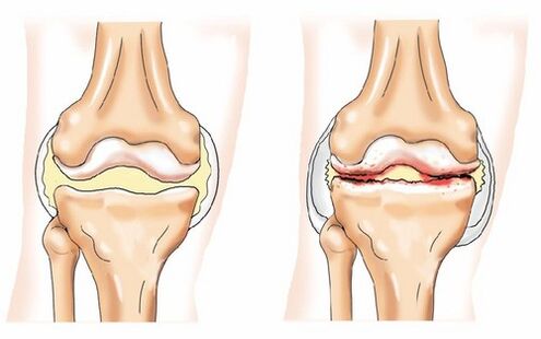 Articolazioni sane e osteoartrite