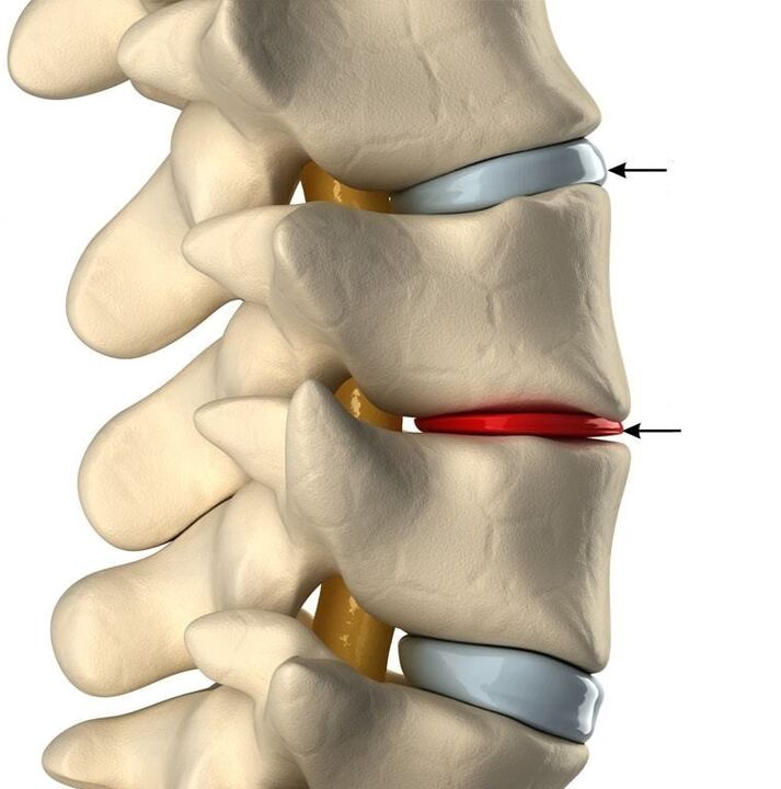 Differenza tra un disco sano e un disco con osteocondrosi