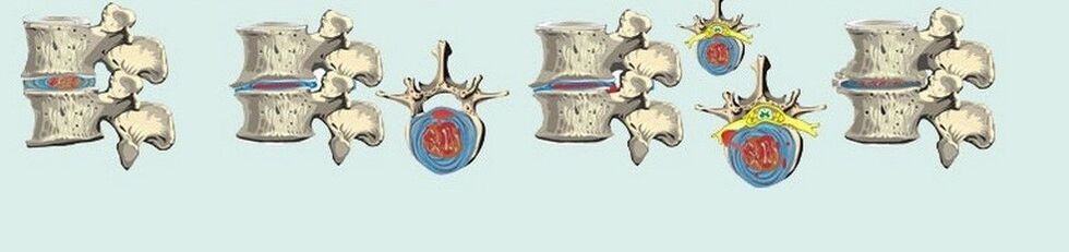 diversi stadi dell'osteocondrosi toracica