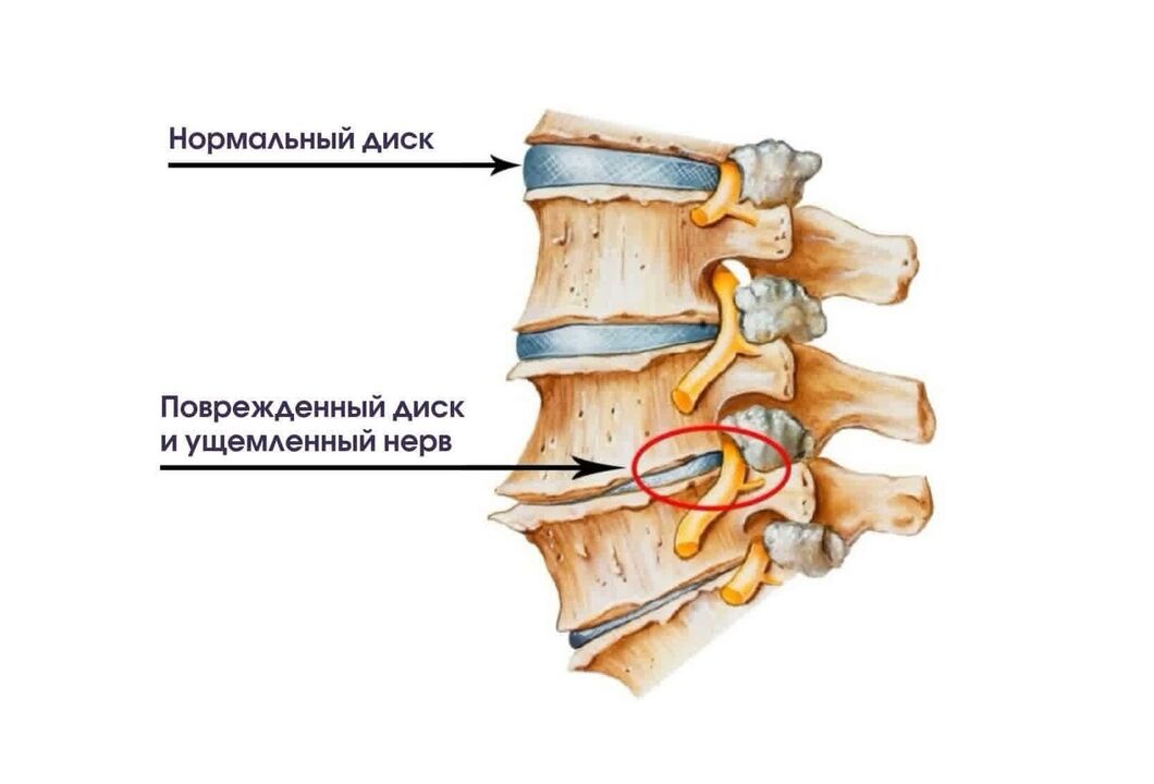 Sintomi dell'osteocondrosi cervicale