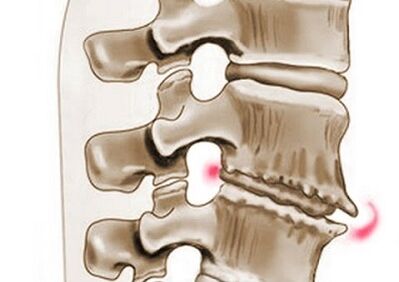 Danni alle vertebre nell'osteocondrosi toracica