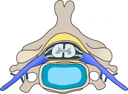 Protrusione nella vertebra con osteocondrosi cervicale