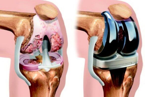 prima e dopo l'artrosi dell'articolazione del ginocchio nell'osteoartrosi